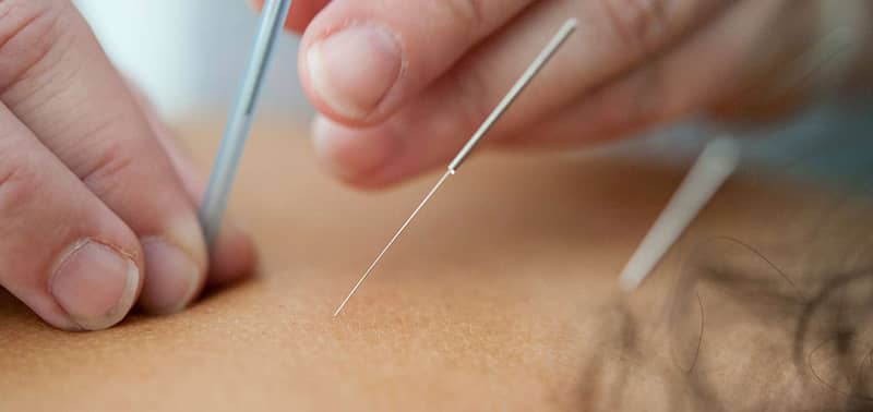 acupuncture training